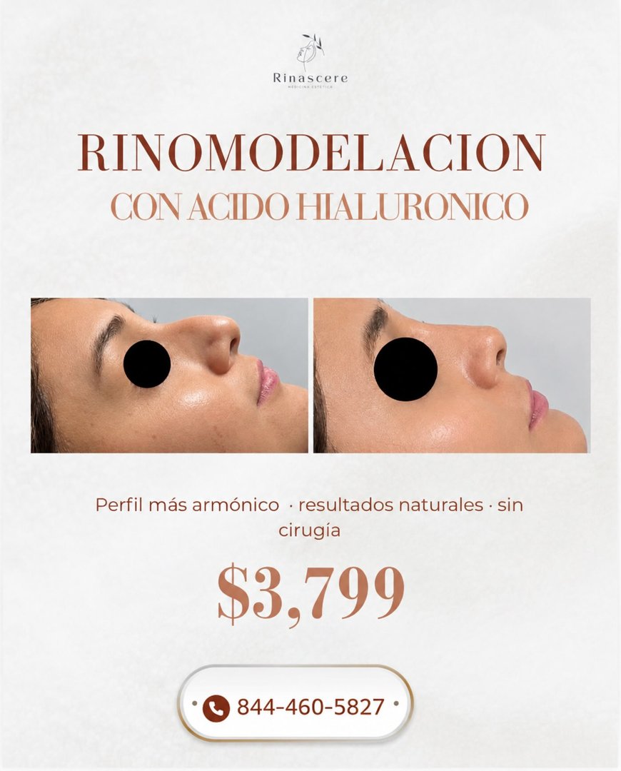 Anuncio de Rinascere: Rinomodelación con ácido hialurónico