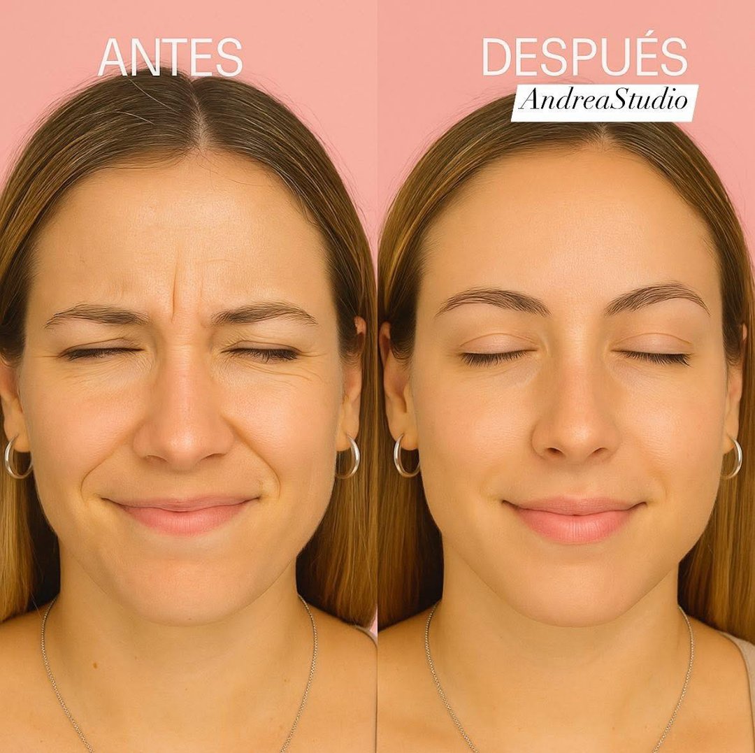 Anuncio de Andrea Rubio Fillers Mx: Botox